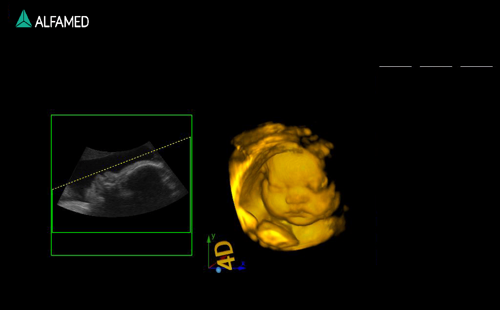 22weeks-fetal-face-by-4D