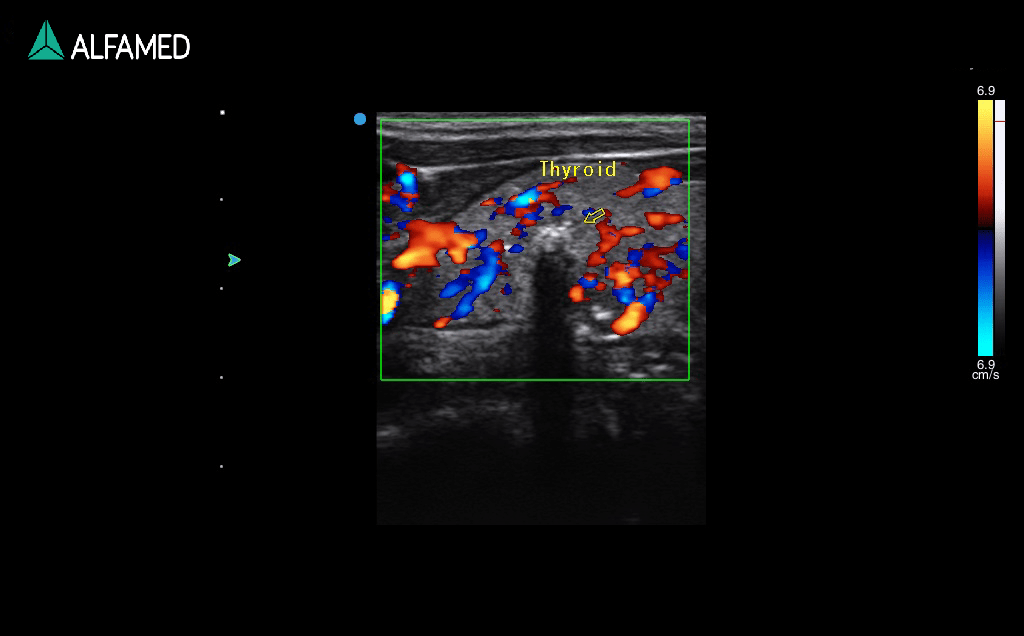 Thyroid-carcinoma-Color-mode