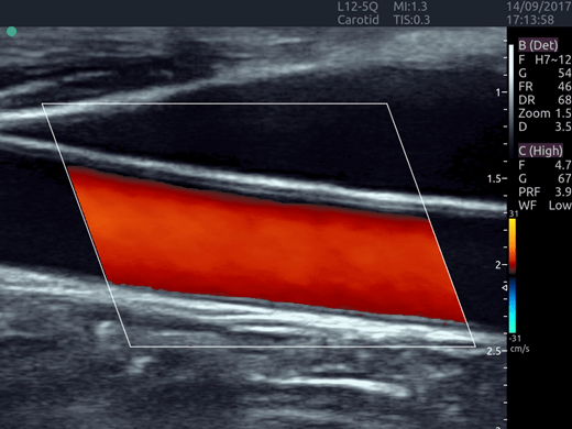carotida-dopler